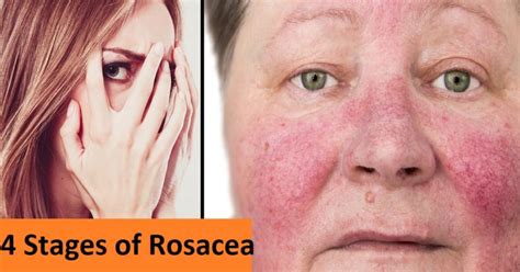 There Are 4 Stages Of Rosacea I Have Stage 2 What Do You Have Cureup