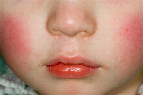 What Is Slapped Cheek Syndrome And What Are The Symptoms Dublin Live