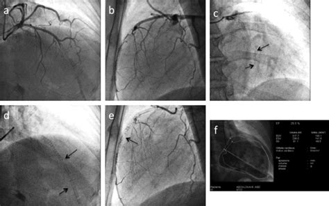 Follow Up Coronary Angiogram 2012 Total Occlusion Intra Stent Of