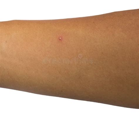 Acne On A Male Arm Stock Photo Image Of Male Skin 150905408