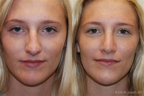 Eric M Joseph Md Rhinoplasty Before After Nasal Straightening With Hump Removal
