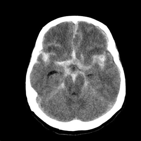 Subarachnoid Haemorrhage Radiology Case
