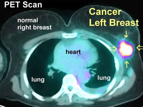 PET Scans In Cancer Cases