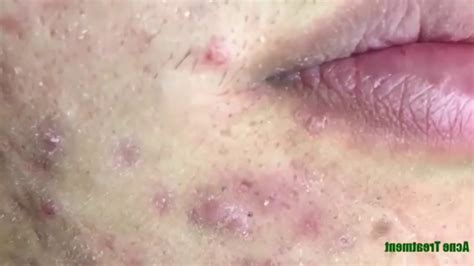 Pimple Popping Blackheads Blackheads Whiteheadson The Face Acne