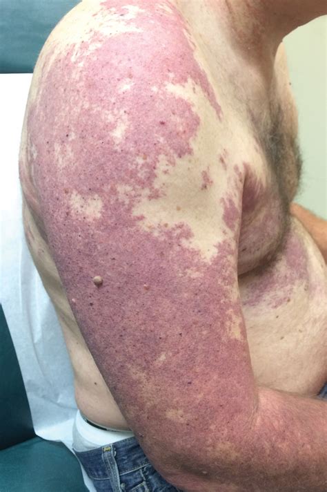 Violaceous Patches On The Arm Mdedge Dermatology