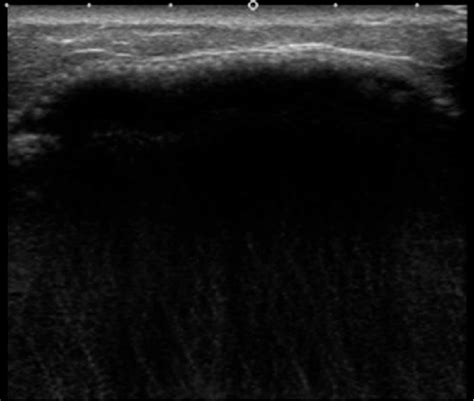 Ultrasound Shows A Linear Hyperechoic Image With Intense Posterior