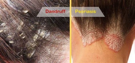 Scalp Psoriasis Vs Dandruff Symptoms Pictures And Causes Vlrengbr