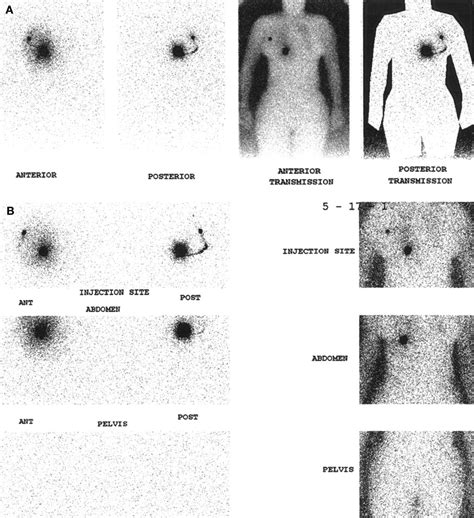 Whole Body Lymphoscintigraphy Using Transmission Scans Journal Of