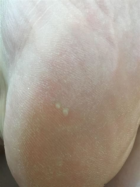 Are These Little White Bumps Warts I Have 7 Total Warts