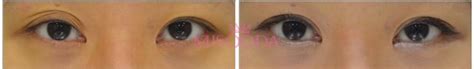 why korean eyelid surgery guide reviews images promotions misooda