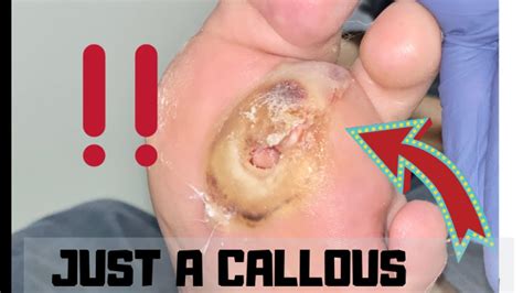 Diabetic Foot Ulcer Debridement Part Diabetes