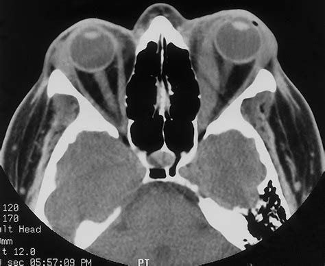 Inflammatory Pseudotumor Radiographics