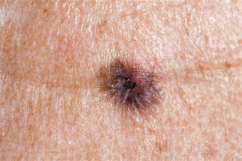 Hope In Stopping Melanoma From Spreading Study Shows That Inhibiting