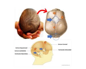 O que é a Craniossinostose ou Cranioestenose Blog São Lucas Hospital