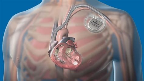Marcapasso Cirurgia De Marcapasso Implante E Manutenção