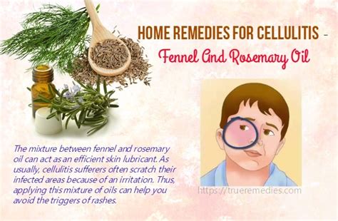 22 Best Home Remedies For Cellulitis Infection On Legs