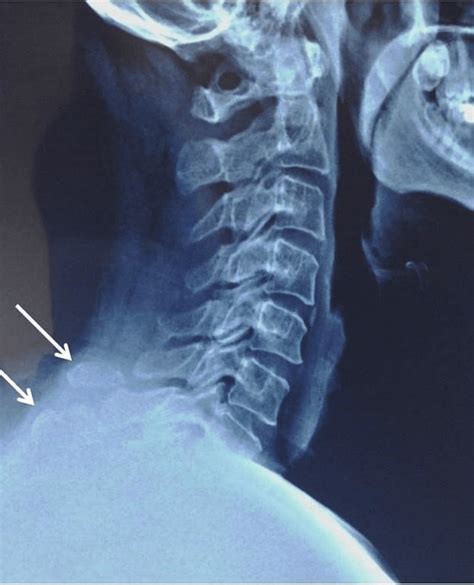 Figure C And C Spinous Process Fracture In The Lateral Radiographs My