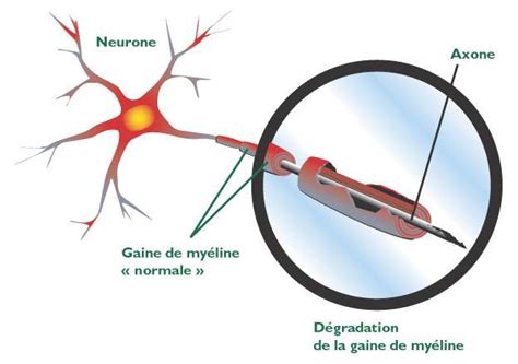 La sclérose latérale amyotrophique ou maladie de charcot. Les symptômes de la sclérose en plaques | Dossier