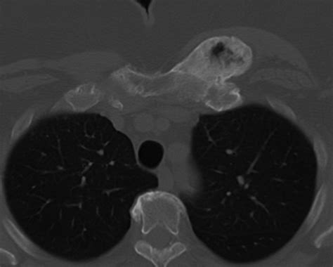 Radiology Of Chest Wall Masses Ajr