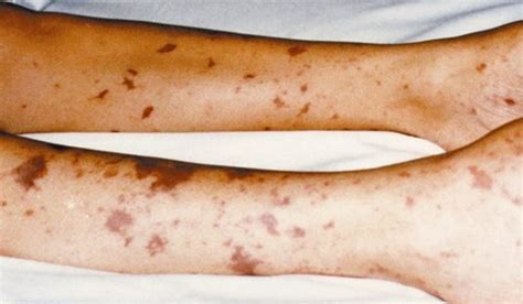 Meningitis Symptoms Treatment Causes Rash Pictures Youmemindbody