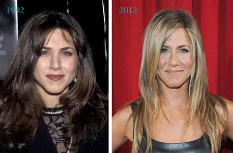 Side effects such as bleeding and an infection may occur depending on individual. Celebrity Nose Jobs (Rhinoplasty) Before & After ...