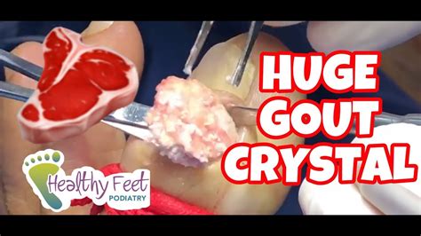 Removing Gout Crystals And How To Prevent Gout Youtube