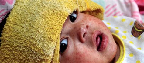 Measles Infection Wipes Our Immune Systems Memory Leaving Us