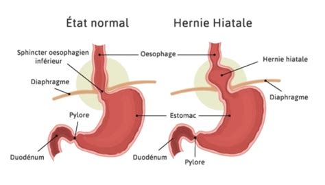 Hernie Hiatale Et Exercices Physiques Reflux Gastro Oesophagien Hot Sex Picture