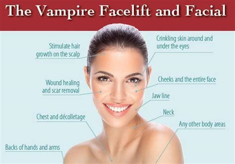 Prp Facial Vampire Facial For Radiant Youthful Skin William Rowland