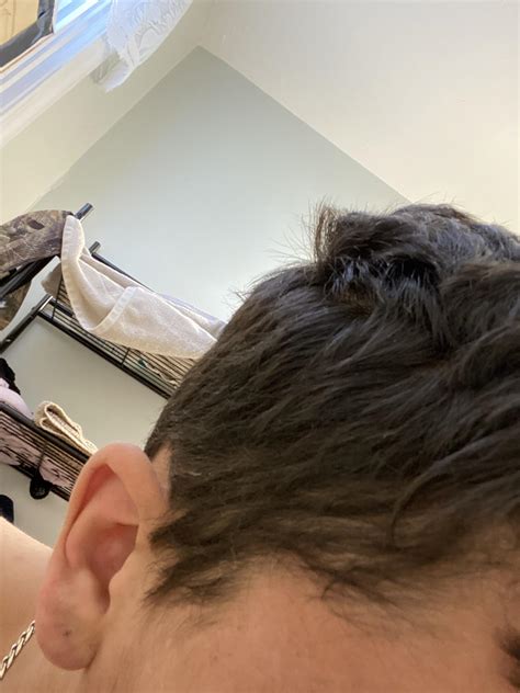 Hair Loss And Thinning On Side Of My Head Is This Temporary Never