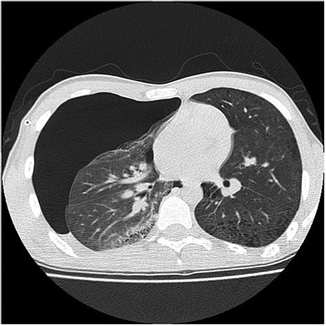 Pneumothorax Ct Scan Images Ct Scan Machine