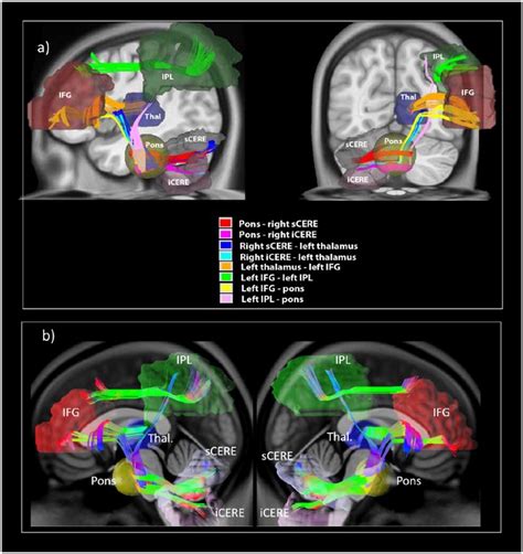 Cerebro Cerebellar Pathways For Verbal Working Memory The Clinical