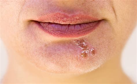 Bleach On Cold Sores Treatments For Cold Sores