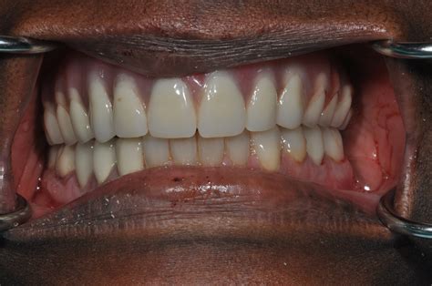 Dental Implants - Montee Tailored Smiles - Dentistry Monteagle, TN