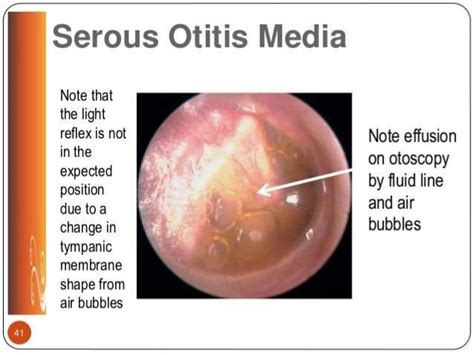 Otitis Media With Effusion