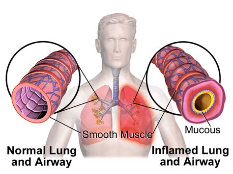 Management Of Mild To Moderate Asthma Exacerbations Rebel Em Emergency Medicine Blog