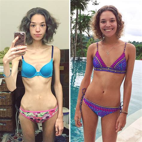 Before After Pics Of People Who Defeated Anorexia Bored Panda