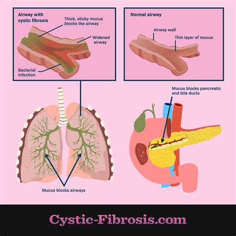 Cystic Fibrosis Lung / Autopsy findings. A, Normal lung. B, Lung affected by 