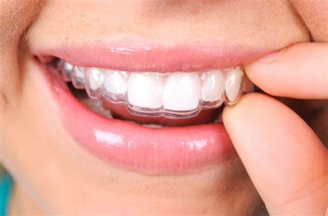 Invisalign Orthodontics Wellington Naenae Dental Clinic