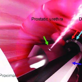 PDF Image Guided Robot Assisted Prostate Ablation Using Water Jet Hydrodissection Initial