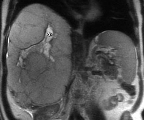 Giant Cavernous Hemangioma Radiographics