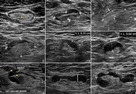 Scielo Brazil Axillary Ultrasound And Fine Needle Aspiration In