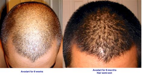 Dutasteride (avodart) capsules for hair loss. Avodart Hair Loss Before And After | Hair Loss