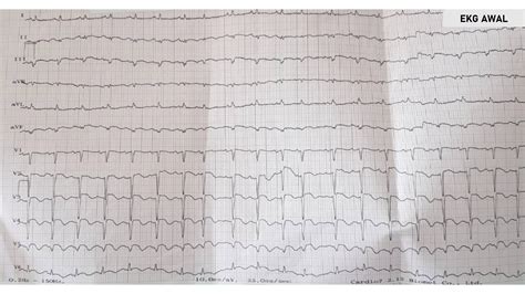 Detail Contoh Gambar Ekg Stemi Koleksi Nomer 11