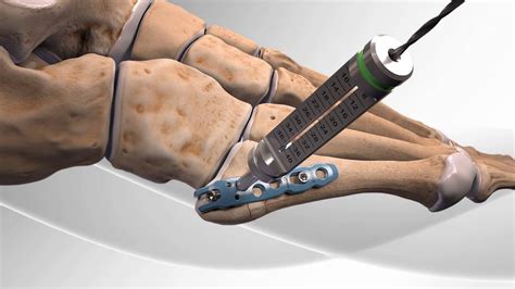 Metatarsal Fracture Repair With Arthrex® Hook Plate Youtube