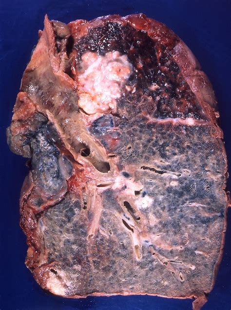 Presently, lung cancer is the second cause of cancer deaths in malaysia. Squamous-cell carcinoma of the lung - Wikipedia