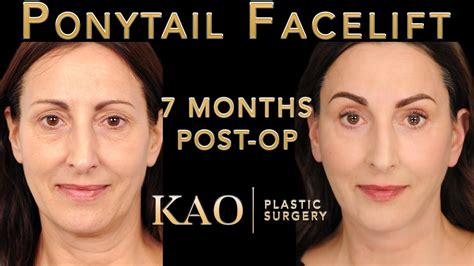 Ponytail Facelift Before And After Video Eyebrow Lift Plastic