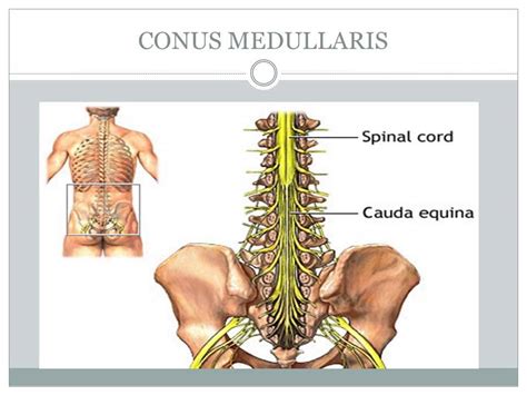 Lower Extremity Impairments Spinal Nerve Roots Conus Medullaris