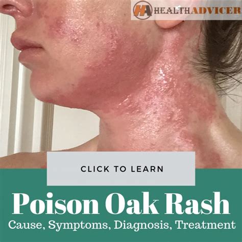 Poison Oak Rash Causes Picture Symptoms And Treatment