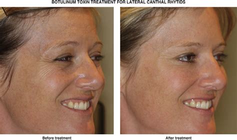 Botulinum Toxin Treatment For Lateral Canthal Rhytids Crows Feet